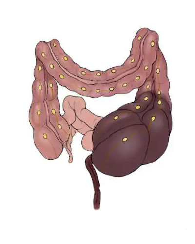 Megacolon.png